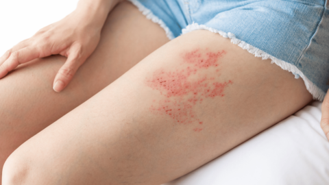 A woman with a painful rash from Shingles (Herpes Zoster)