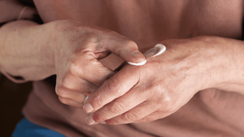 Woman rubbing potent topical corticosteroid on her hands