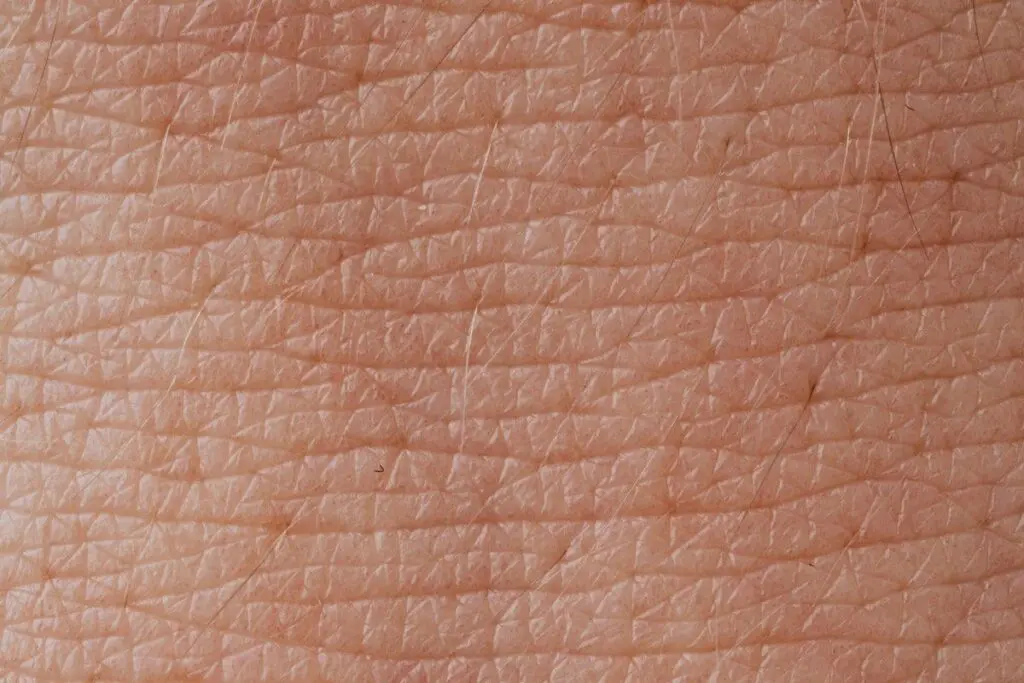 Skin after the effective treatment of hives with prednisone