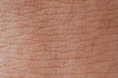 Skin after the effective treatment of hives with prednisone